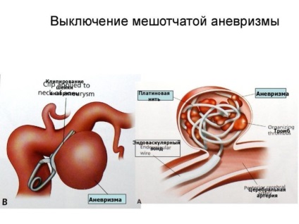 Subarachnoidealis vérzés típusok, okai, tünetei, diagnózisa, kezelése,