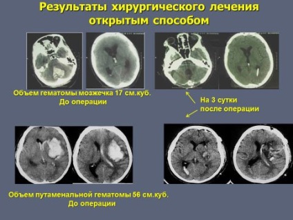 Subarachnoidealis vérzés típusok, okai, tünetei, diagnózisa, kezelése,