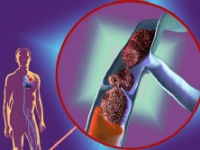 Thromboembolia típusok, okai, tünetei az artériás és vénás kezelést