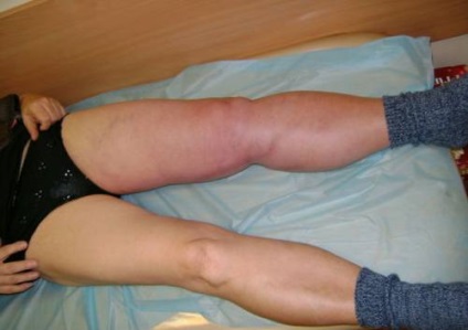 Thromboembolia típusok, okai, tünetei az artériás és vénás kezelést