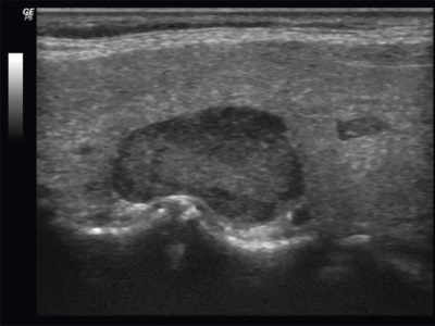 Uzi mellékpajzsmirigy adenoma technika