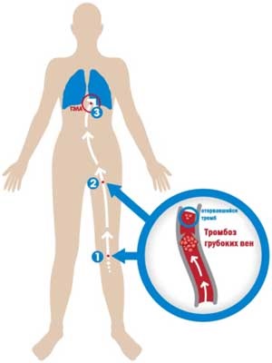 Vénás tromboembólia jelek és tünetek, a kezelés és a megelőzés a trombózis és tüdőembólia
