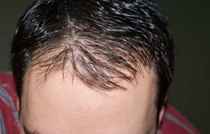Típusú alopecia, az alapokat a besorolás meghatározása a típusú hajhullás (alopecia megtekintés) Típusú alopecia, az alapokat a besorolás meghatározása a típusú hajhullás