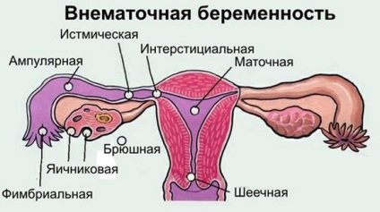 Méhen kívüli terhesség (ovum TERHESSÉG csatolva) méhen kívüli terhesség