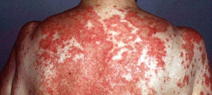 Lupus milyen betegségben, fotók, tünetek, kezelés (tünetek) Lupus milyen betegségben, fotók, tünetek, kezelés