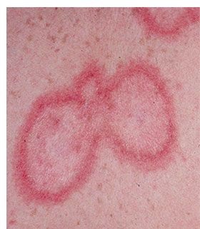 Lupus milyen betegségben, fotók, tünetek, kezelés (feldolgozás) Lupus milyen betegségben, fotók, tünetek, kezelés