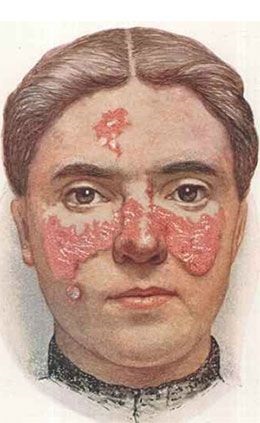 Lupus milyen betegségben, fotók, tünetek, kezelés (fotó) Lupus milyen betegségben, fotók, tünetek, kezelés
