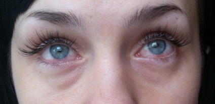 Allergia szempillák, mit kell tennie, ha ő lehet tekinteni, mint egy kép
