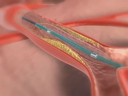 Az angioplasztika - az előnyöket, jellemzők kezelések
