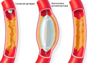 Az angioplasztika - az előnyöket, jellemzők kezelések