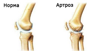 Osteoarthritis a térd ízületi gyulladás