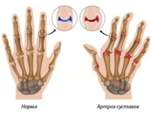 Osteoarthritis az ujjak, hogyan kell kezelni iskryvlenie ízületek kezelésére deformáció ujjak népi