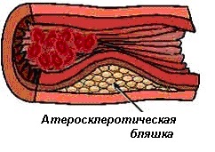 Atherosclerosis az artériák az alsó végtagok