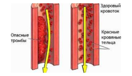 Autonóm műszív - jelzések és implantáció