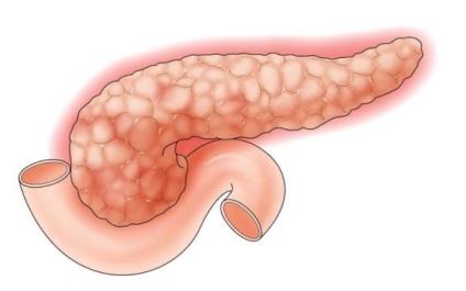 Biliaris pancreatitis, krónikus és akut