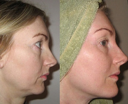 Bioreinforcement arc hatékonyság bionitey, áttekintésre, ár, fotók előtt és után