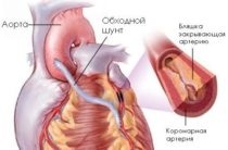Knott-kór okai, tünetei, kezelése (okok) Knott-kór okai, tünetei, a kezelés