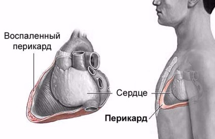 Fájdalom a szív inhalálás során - okai, módszerek válasz a problémára (szív) Fájdalom a szív inhalálás során - okozza, módszerek reagál a probléma