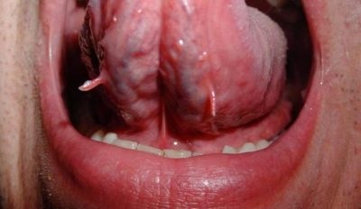 Szemölcsök a szájban és a nyelven okokat és hogyan kell kezelni a gumikat