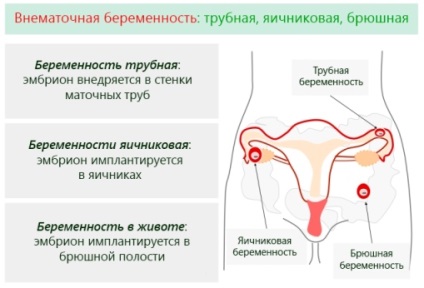 Hasi terhesség tünetei, diagnózis és kezelés