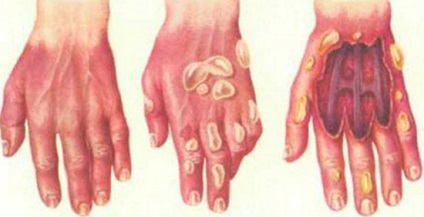 hólyagos dermatitis tünetei és kezelése hólyagos dermatitis kezében