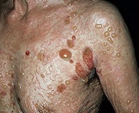 hólyagos dermatitis tünetei és kezelése hólyagos dermatitis kezében