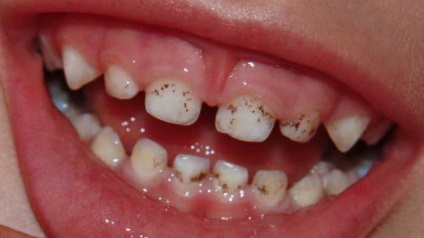 Fekete foltok a fogakon barna foltok fogszuvasodás
