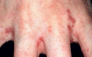 Hogyan kell kezelni a rüh gyorsan sprosidermatologa (milyen gyorsan gyógyítja rüh) Hogyan kell kezelni a rüh gyorsan sprosidermatologa