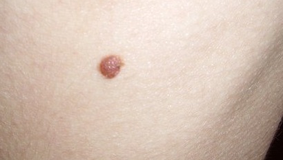 Mi van, ha karcos mol, bőrbetegségek (erősen viszkető mol) Mi van, ha karcos mol, bőrbetegségek