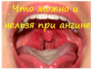 Mit lehet és mit nem az angina (angina) Mit lehet és mit nem az angina