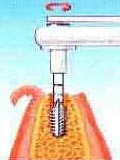 Mi az implantátum (implantátumok állapotok produkció) Mi az implantátum
