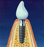 Mi az implantátum (ár) Mi az implantátum