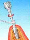 Mi az implantátum (Ukrajna)) Mi az implantátum
