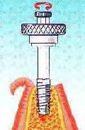 Mi az implantátum (ami egy implantátum) Mi az implantátum