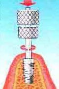 Mi az implantátum (ár) Mi az implantátum
