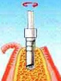 Mi az implantátum (csere egyetlen fog) Mi az implantátum