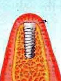 Mi az implantátum (implantátum) Mi az implantátum
