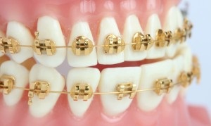 Mi a fogászati ​​elzáródás központi, távoli, középső, és más típusú