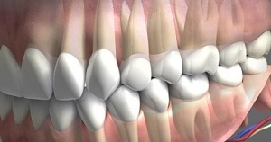 Mi a fogászati ​​elzáródás központi, távoli, középső, és más típusú