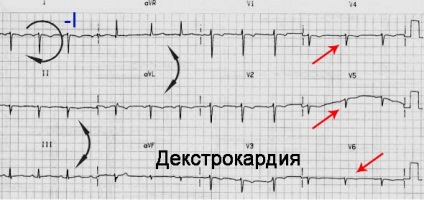 Dextrocardia jellemzői és okai (jellemzők) Dextrocardia sajátosságainak és okai