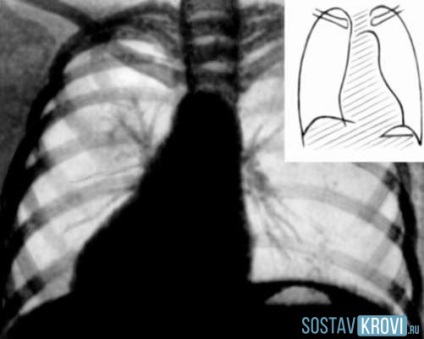 Dextrocardia okok, tünetek, diagnózis az EKG, a kezelés és a szövődmények