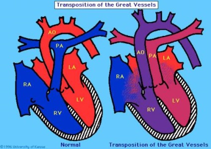Dextrocardia szív tünetek és EKG, hatások, a kezelés