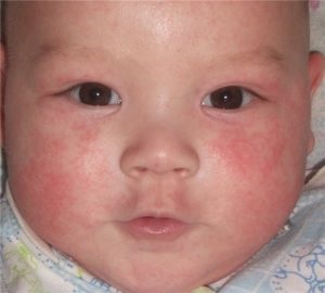 Dermatitis az arcon gyermek okoz, tünetei, kezelése