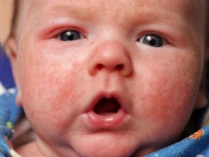 Dermatitis az arcon gyermek okoz, tünetei, kezelése