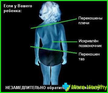 Gyermek scoliosis képekben (terhesség és gyermek) Gyermek gerincferdülés képekben