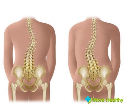 Gyermek scoliosis Picture (scoliosis) Gyermek gerincferdülés képekben