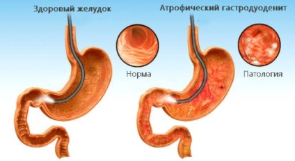 Diéta gastroduodenite menüben orvoshoz