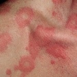 Diéta csalánkiütés - a felnőtt, gyermek menü, hipoallergén, táplálkozás akut (urticaria) Diéta csalánkiütés - a felnőtt, gyermek menü, hipoallergén, a táplálkozás az akut