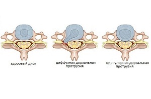 Háti lemez kiemelkedés mi ez, és hogyan kell kezelni, és a patológia