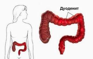 Duodenitis tünetei és kezelése